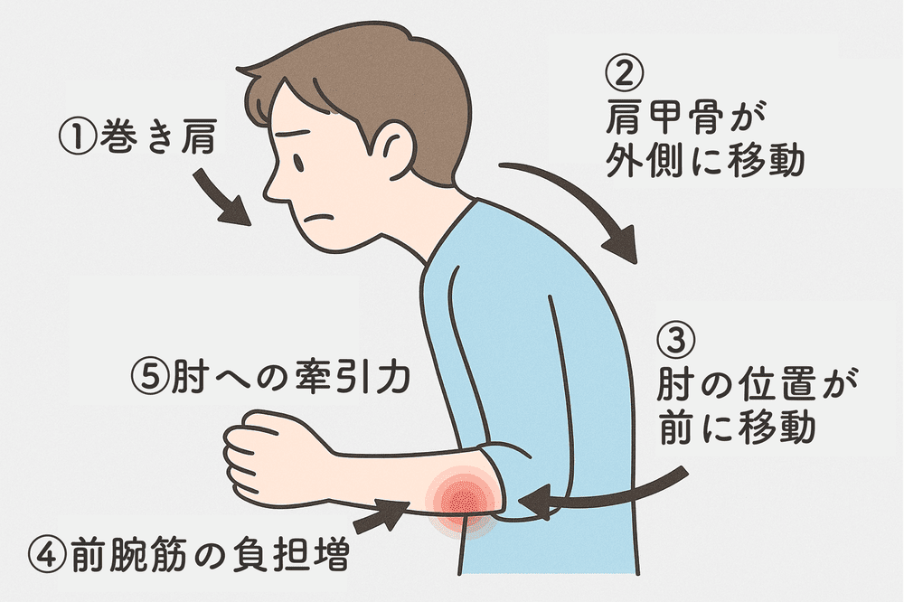 整形外科や薬でテニス肘が改善しない理由|新潟市中央区 つばさ整骨院・整体院