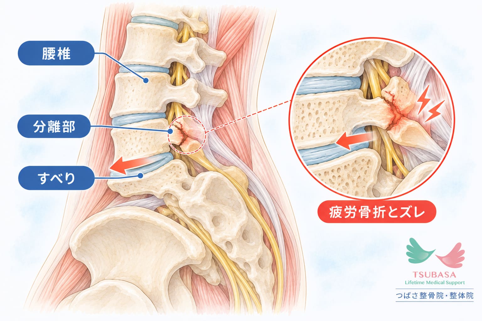 腰椎分離症・すべり症の原因と症状の説明イラスト|新潟市中央区 つばさ整骨院・整体院