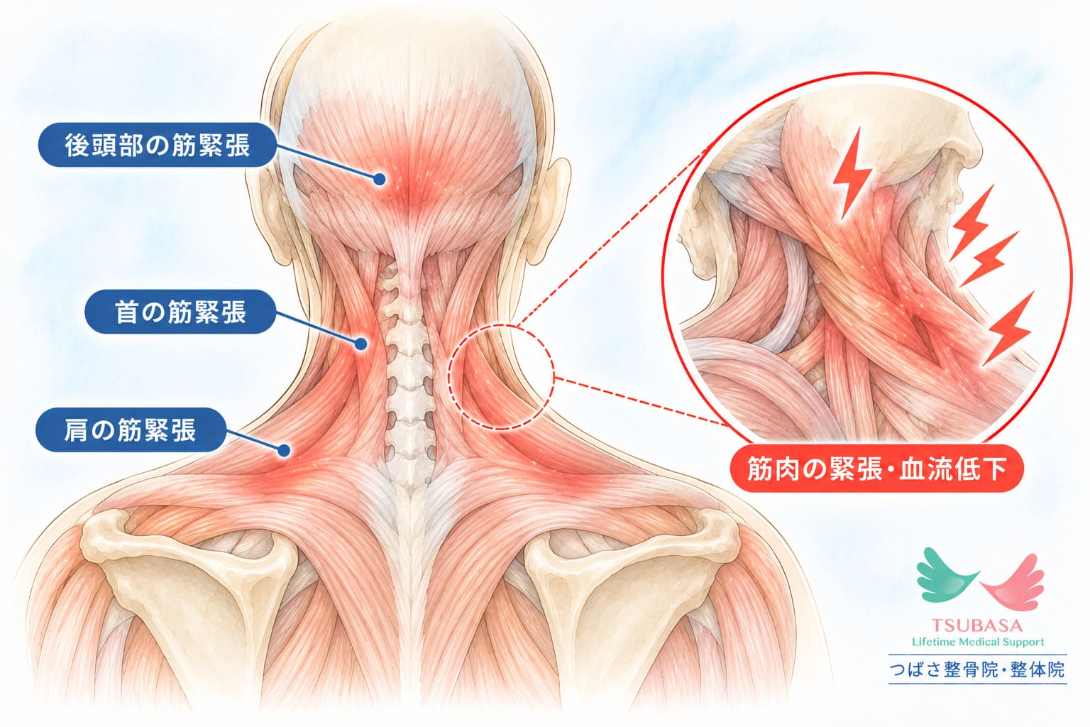 頭痛（緊張型頭痛・片頭痛）の原因と症状の説明イラスト｜新潟市中央区 つばさ整骨院・整体院