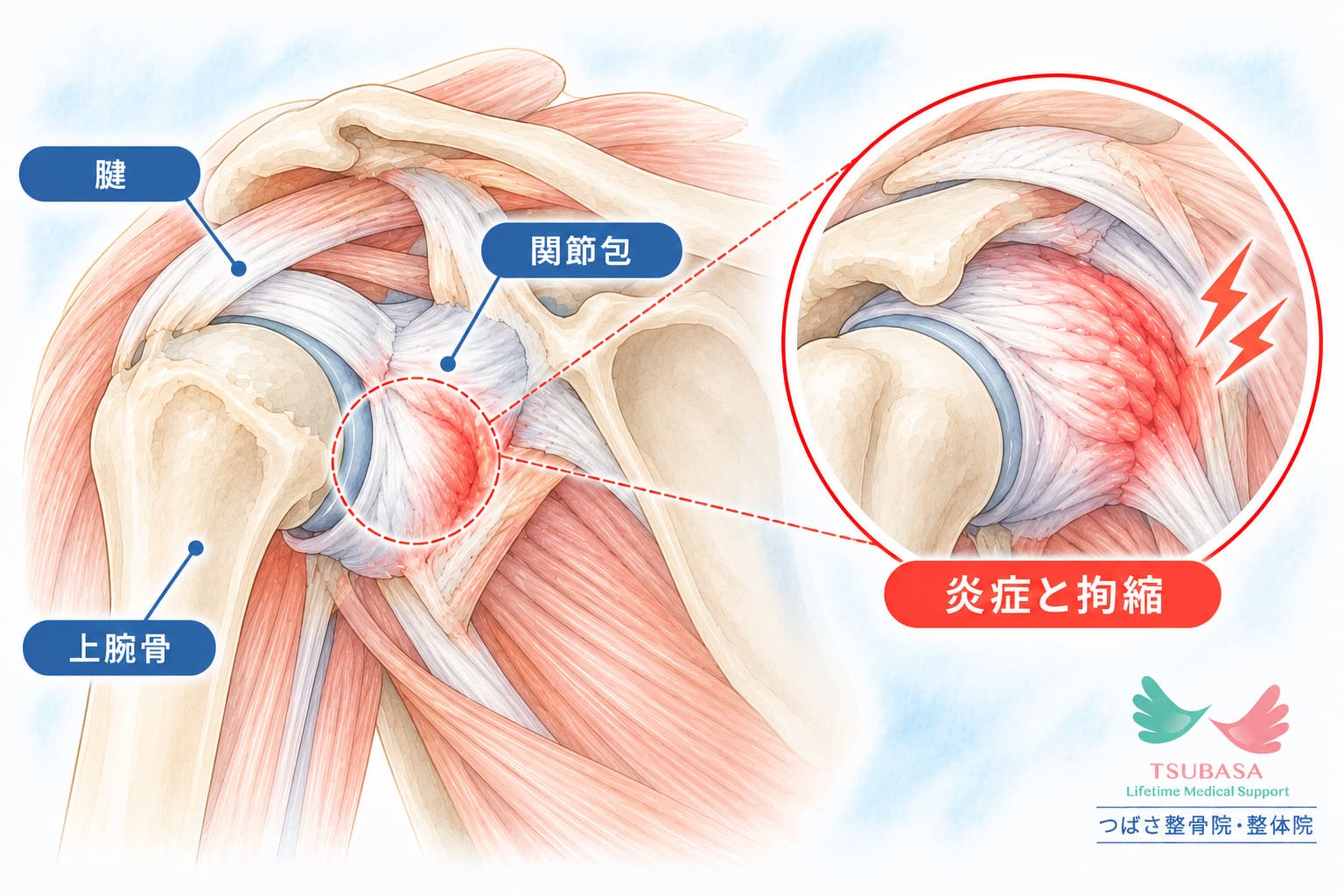 四十肩・五十肩（肩関節周囲炎）の原因と症状の説明イラスト｜新潟市中央区 つばさ整骨院・整体院