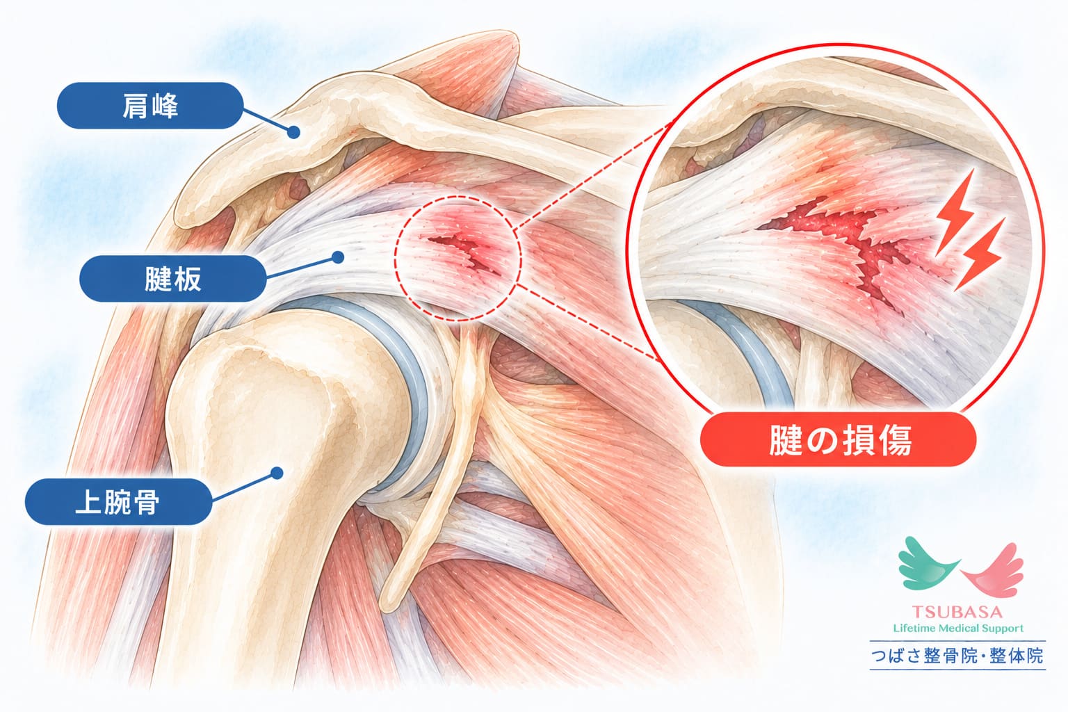 腱板損傷の原因と症状の説明イラスト｜新潟市中央区 つばさ整骨院・整体院