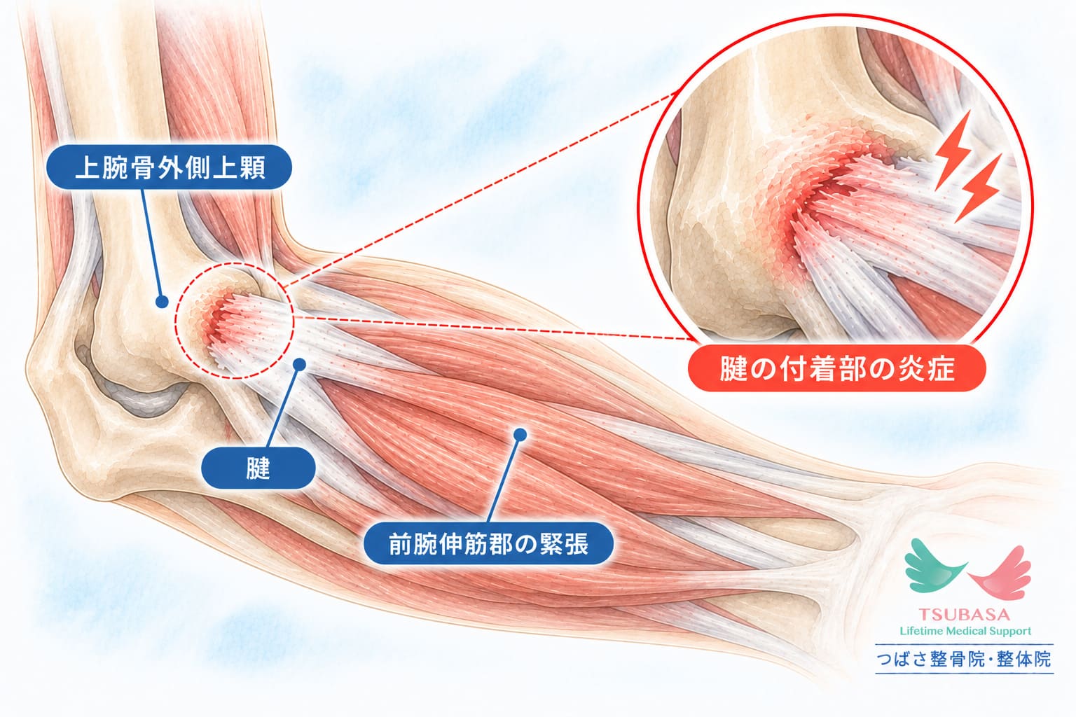 テニス肘(上腕骨外側上顆炎)の原因と症状の説明イラスト|新潟市中央区 つばさ整骨院・整体院